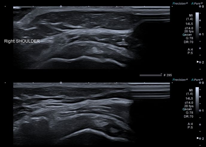 Ecografia Osteoarticular